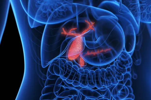 8 جوانب طبية حول حصوات المرارة وعلاجها الجراحي