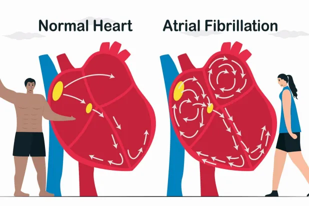 من اليسار: القلب السليم مقابل القلب المصاب بالرجفان الأذيني (غيتي)