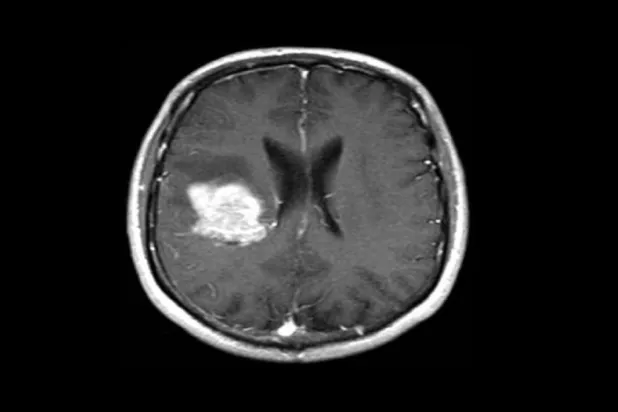 Beyin taramasında solda katı bir tümörün beyaz kitlesi görülüyor (UCLA)