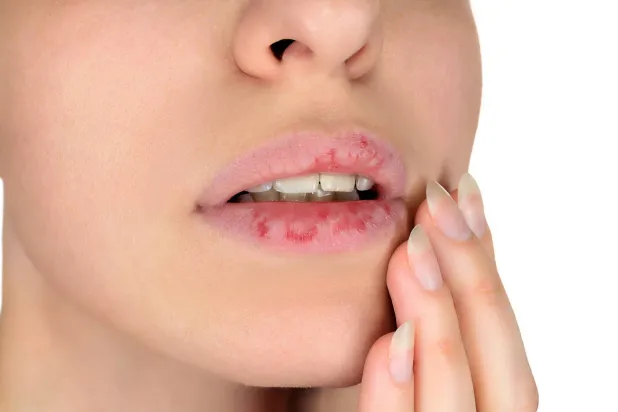 علاج جيني لجفاف الفم