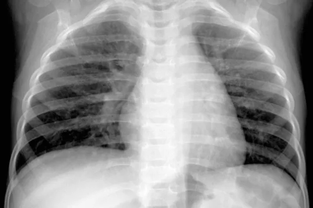 ما نعرفه عن «الميتانيوفيروس البشري» المنتشر في الصين