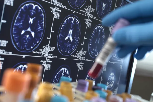 هل تتسبب العدوى في بعض حالات ألزهايمر؟