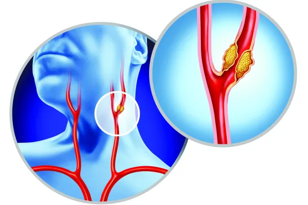 علاج انسداد شرايين العنق يقلل مخاطر الجلطة الدماغية