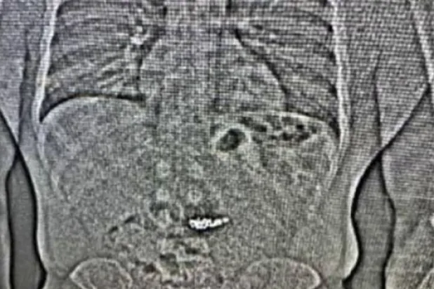 صورة أشعة تُظهر أقراطاً تمت سرقتها من متجر مجوهرات وسط فلوريدا (أ.ب)