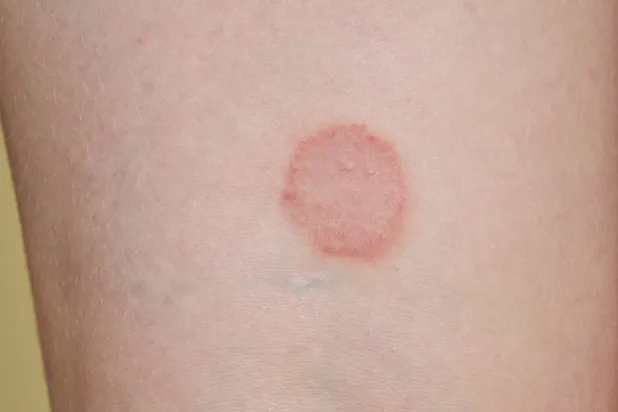 «الحزَّاز المسطَّح»... علاجات موجهة واعدة