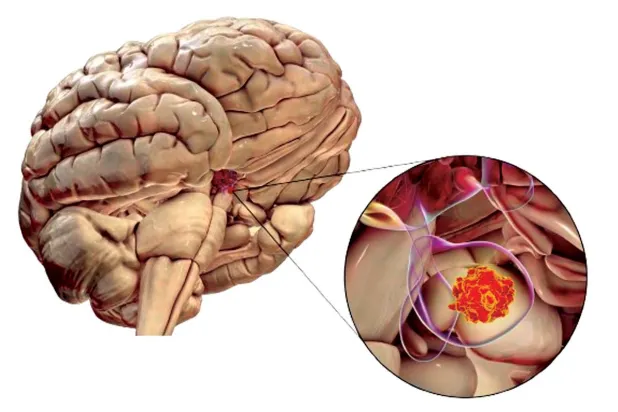 التصوير الفلورسنتي... ثورة في جراحة الدماغ