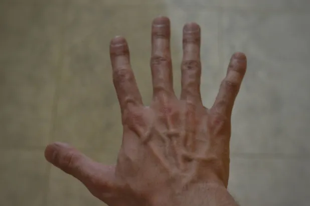 استشارات: انتفاخ أوردة ظاهر اليد