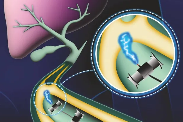 جراحة كهربائية لعلاج انسداد القنوات الصفراوية بواسطة روبوتات مصغرة (المركز الألماني لأبحاث السرطان)