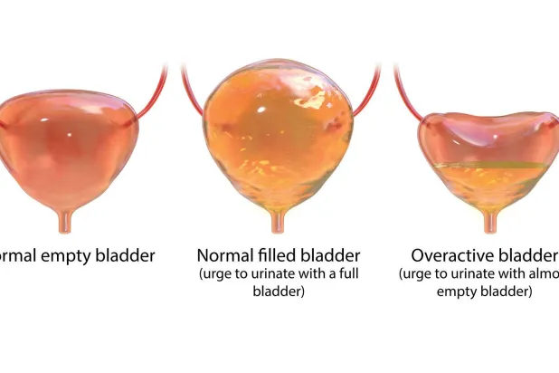 من اليسار: مثانة طبيعية فارغة ثم مثانة طبيعية ممتلئة - إلحاح التبول نتيجة امتلائها ثم فرط نشاط المثانة - إلحاح التبول لمثانة شبه فارغة