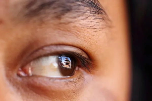 التنكس البقعي يصيب ملايين الأشخاص حول العالم (رويترز)