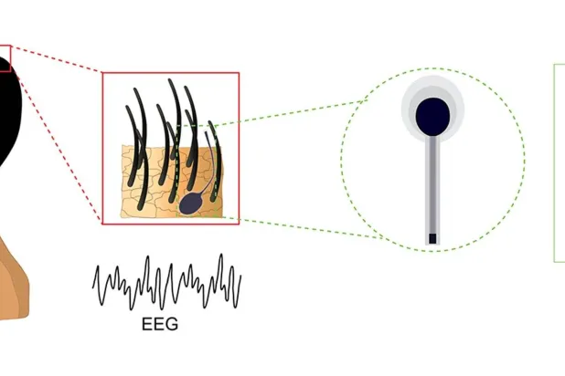 يثبّت الجهاز مباشرةً على فروة الرأس (جامعة ولاية بنسلفانيا)