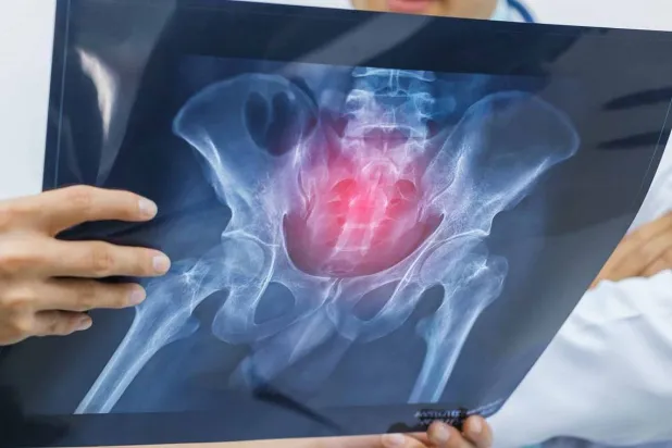 مرض هشاشة العظام يؤثر على العمود الفقري (جامعة هدرسفيلد البريطانية)