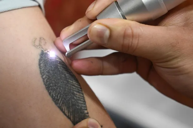 رجل يزيل وشماً من ذراع مواطن في الهند (أ.ف.ب)