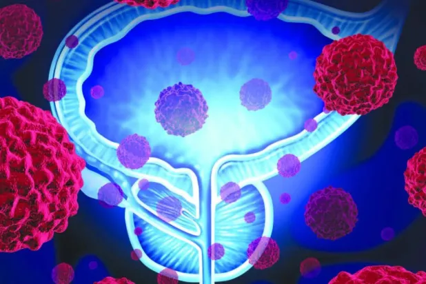 إمكانية لاكتشاف سرطان البروستاتا في مراحله المبكرة