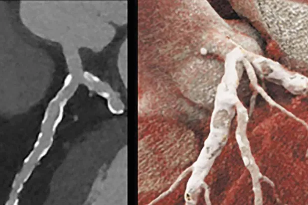 التصوير المقطعي المحوسب للشريان التاجي... اختبار متقدم لتشخيص أمراض القلب