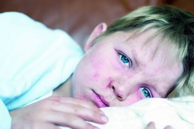 قلة الوعي والمعلومات المضللة من أسباب تفشي الحصبة في أميركا