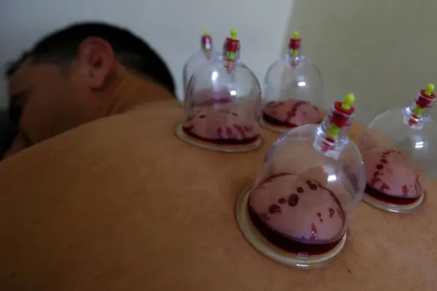 تعتمد الحجامة على مبدأ الشفط فتُوضع كؤوس على الجلد لإحداث ضغط سلبي يجذب الدم إلى السطح مما يعزز الدورة الدموية ويحفز عملية الشفاء (رويترز)