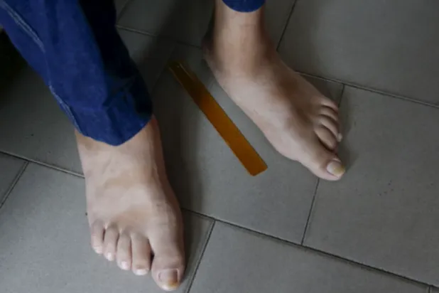 تورم القدمَين قد يشير إلى عدد من المشكلات الصحية (رويترز) 