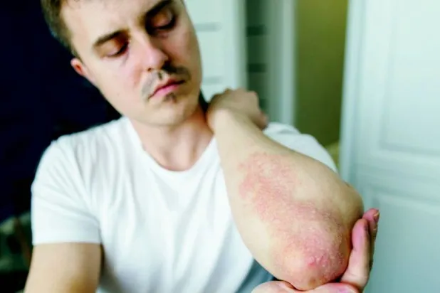 الصدفية... مرض مناعي ذاتي يؤثر على ملايين الأشخاص حول العالم