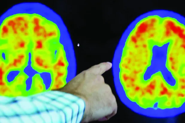 فحوص تصوير مقطعي لشخص مصاب بألزهايمر (رويترز)