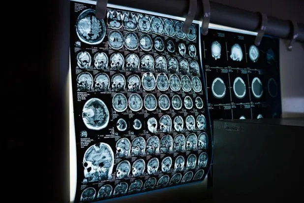 يرى الباحثون أن هذا الاختبار قد يشكل أداة زهيدة التكلفة لمن يواجهون صعوبة في الحصول على تشخيص (بكساباي)