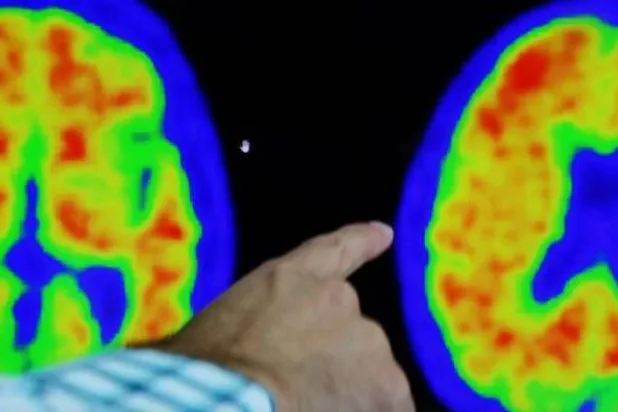 يوجد نحو من 20 إلى 25 في المائة من الكولسترول بالجسم في الدماغ (أرشيفية - رويترز)