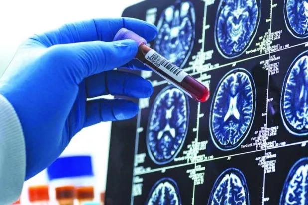اختبار الدم الجديد للكشف عن ألزهايمر: ماذا يعني لمجال التشخيص؟