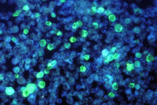 اختراق علمي يوضح كيف يُسرّع «فيروس إبشتاين-بار» نمو سرطان البلعوم الأنفي