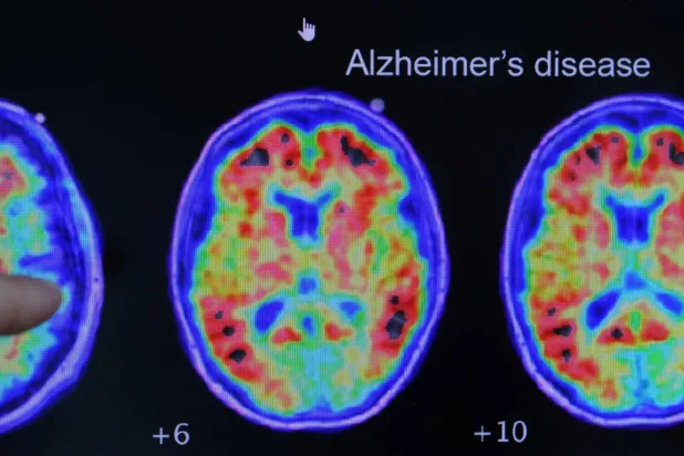 دليل على مرض ألزهايمر يظهر في فحوصات التصوير المقطعي بالإصدار البوزيتروني (رويترز)