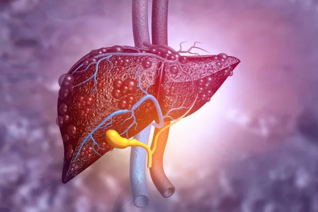 أمراض الكبد تؤدي لتلف تدريجي في الأنسجة وإضعاف قدرة الكبد على أداء وظائفه الأساسية (معهد كارولينسكا)