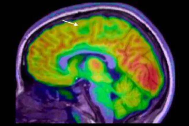الذكاء الاصطناعي يساعد في تشخيص «الصرع»