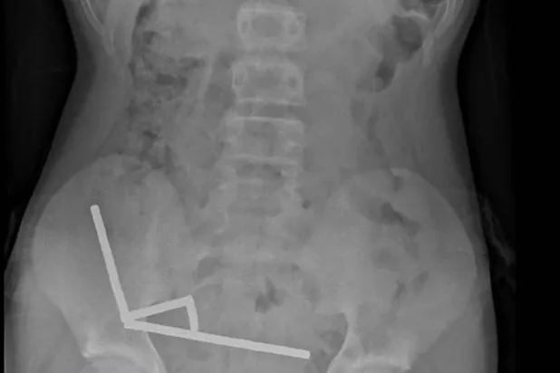 This undated handout released on October 24, 2025 from the New Zealand Medical Journal (NZMJ) shows an x-ray image of pieces of high-power magnets clumped up in the intestines of a New Zealand teenager in Tauranga. Handout / NEW ZEALAND MEDICAL JOURNAL (NZMDJ)/AFP
