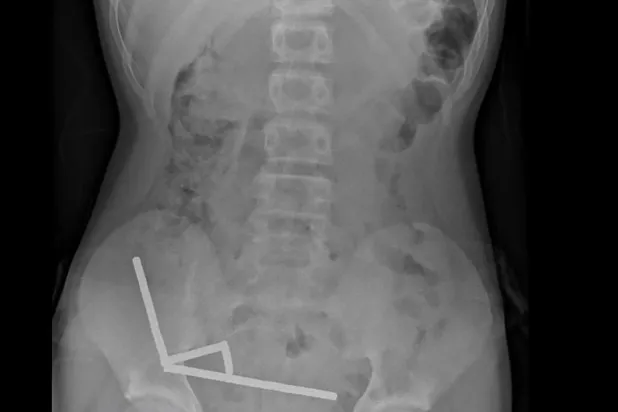 صورة أشعة سينية لقطع المغناطيس متكتلة في أمعاء المراهق النيوزيلندي (أ.ف.ب)
