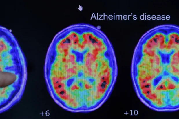 إحدى المشكلات الرئيسية المُصاحبة لمرض ألزهايمر تكمن في أنه يبدأ قبل وقت طويل من اكتشاف الأعراض (رويترز)