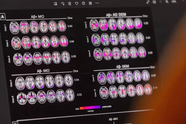 الخرف هو مجموعة من الاضطرابات الإدراكية التي تؤدي إلى تراجع في الذاكرة والتفكير والقدرات الذهنية الأخرى (أرشيفية - رويترز)