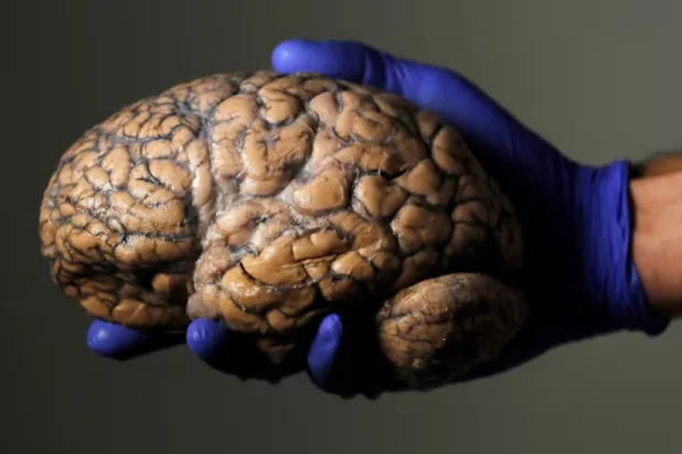 A researcher holds a human brain, part of a collection of more than 3,000 brains at the psychiatric hospital in Duffel, Belgium, July 19, 2017. REUTERS/Yves Herman 