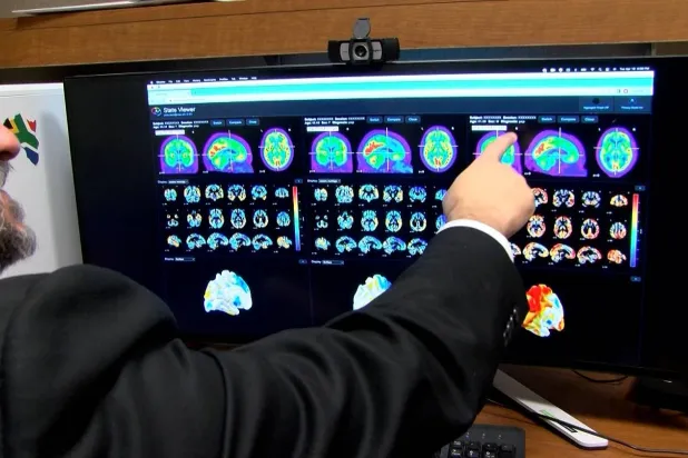 ألزهايمر يؤدي لتراكم بروتينات في الدماغ تسبب تلف الخلايا العصبية وفقدان الوظائف العقلية (مايو كلينك)