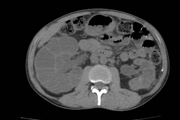 تصوير مقطعي محوسب لكلية مصابة بالتكيسات والحصى