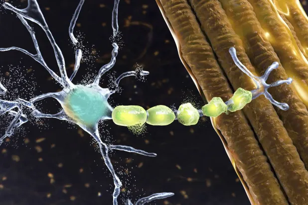 شكل تصويري بالكمبيوتر لتدهور الخلايا العصبية المسبب للأمراض العصبية الحركية