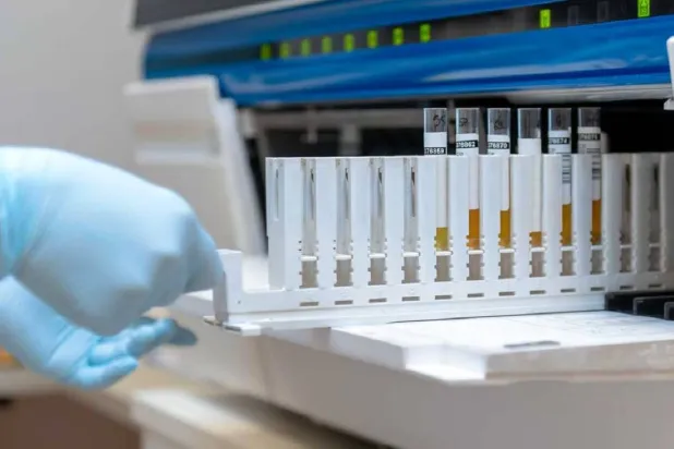 الفحص الجديد يعتمد على عينة بول لتشخيص سرطان المثانة بدقة (مركز موفيت للسرطان في أميركا)