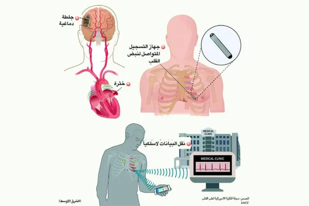 استشارات: مُسجِّل مزروع لرصد نبضات القلب - إزعاج غازات البطن