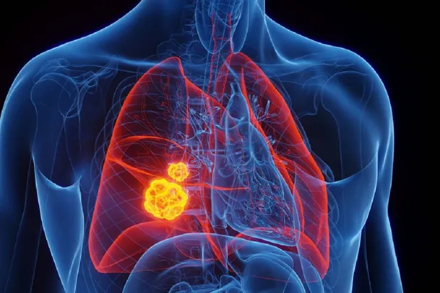 سرطان الرئة يتميز بسرعة نموه وانتشاره إلى أعضاء أخرى في الجسم (جامعة ميامي)