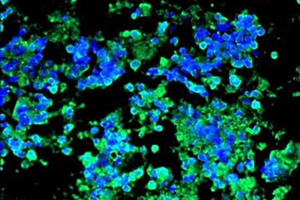 صورة من مختبر الباحث إدوارد باتز تظهر فيها نوى الخلايا السرطانية في الرئة باللون الأزرق وهي ترتبط بالأجسام المضادة «جي تي 103» باللون الأخضر