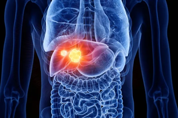 سرطان الكبد من أكثر أنواع السرطان خطورة وانتشاراً في العالم (جامعة فلوريدا)