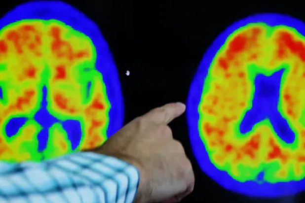 التعرّف إلى أعراض السكتة الدماغية وفهم عوامل الخطر يظلّان خط الدفاع الأول للوقاية منها (أرشيفية - رويترز)