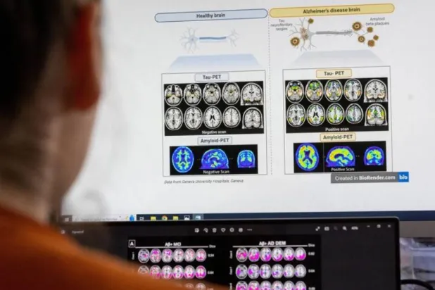 اختبار بسيط قد يتنبأ بأعراض «ألزهايمر» قبل سنوات