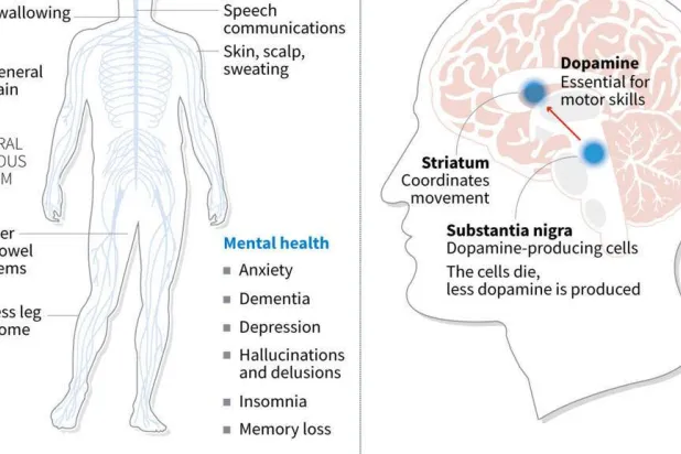 Parkinson's disease. John SAEKI, Adrian LEUNG / AFP
