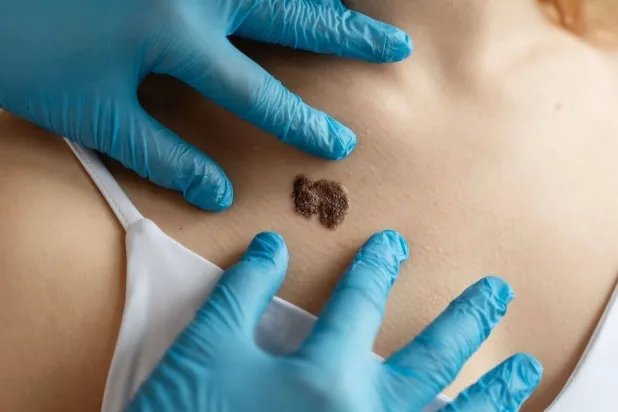 دراسة أسترالية تتوقع انخفاض معدل الإصابة بسرطان الجلد بين الأطفال