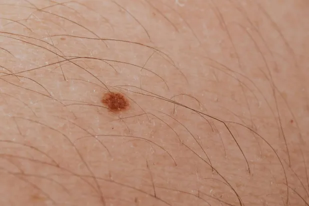 توقعات بانخفاض في خطر الإصابة بسرطان الجلد بعد الانخفاض في عدد الشامات التي يصاب بها الأطفال (بيكسلز)