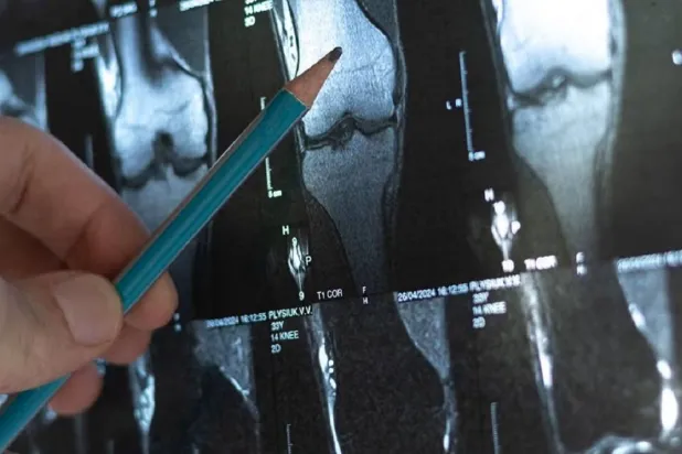 سرطان العظام يظهر عادة في الأطراف مثل عظام الساق (جامعة كيس ويسترن ريزيرف)